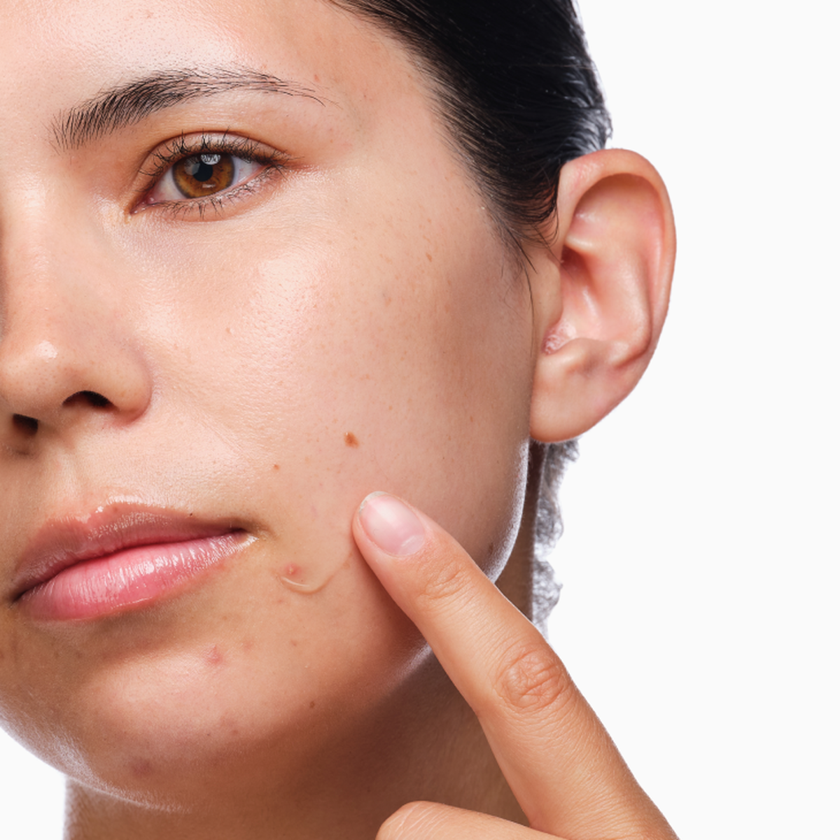 the-acne-set-k9 rdn-the-acne-set-application.png
