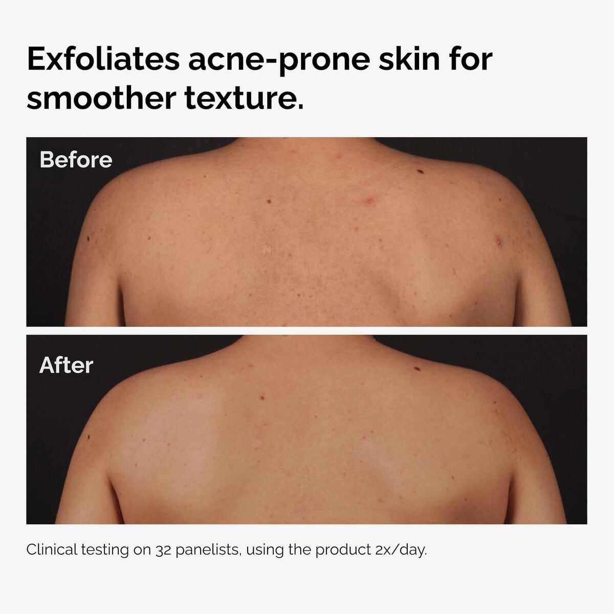 salicylic-acid-0-5-body-serum-t3 ord-salicylic-acid-body-serum-before-after-graphic-NA.jpg