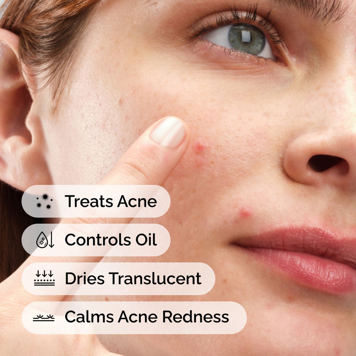 sulfur-10-powder-to-cream-concentrate-t0 ord-sulfur-10pct-powder-to-cream-concentrate-model-application-with-benefits-acne.jpg